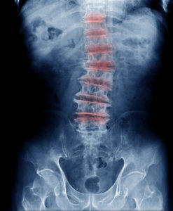 long-term-effects-of-scoliosis